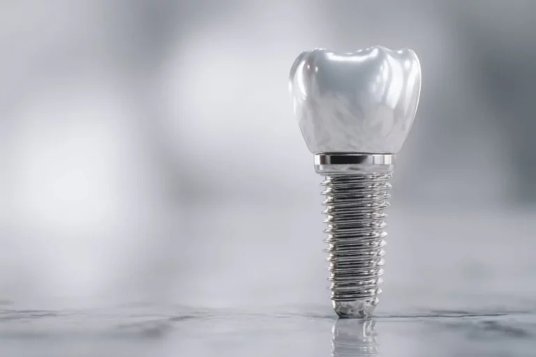 dental implant showing titanium post, abutment, and crown for tooth replacement