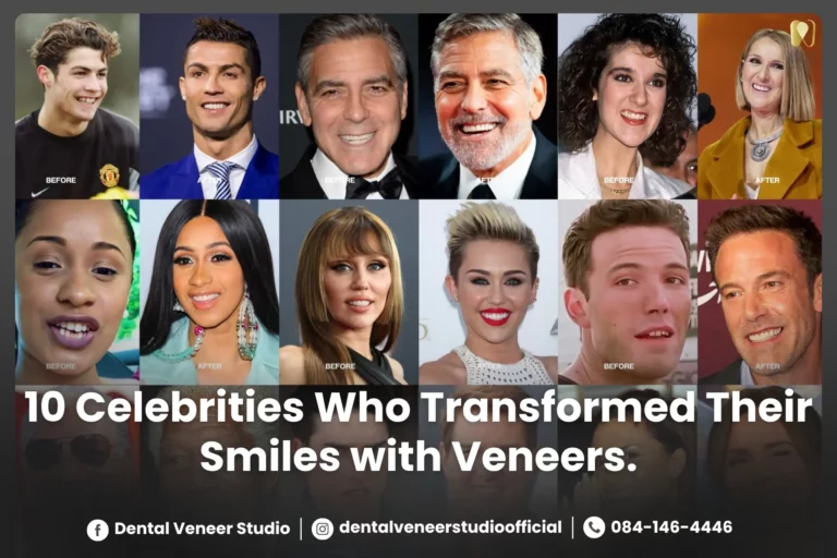 10 Celebrities Who Transformed Their Smiles with Veneers.