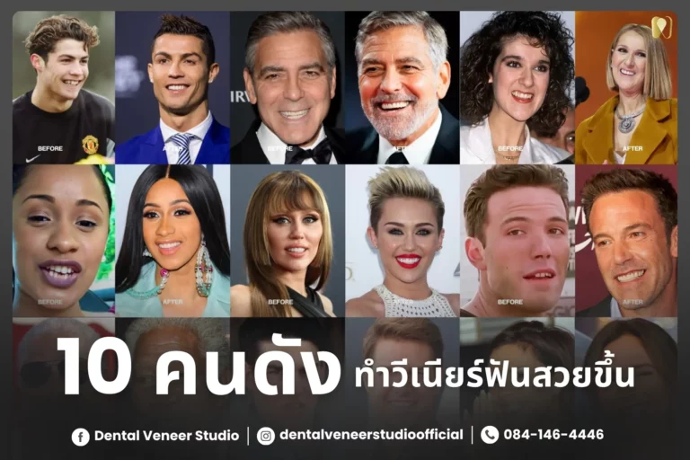 10 คนดังเผยเคล็ดลับฟันสวยด้วย “วีเนียร์”