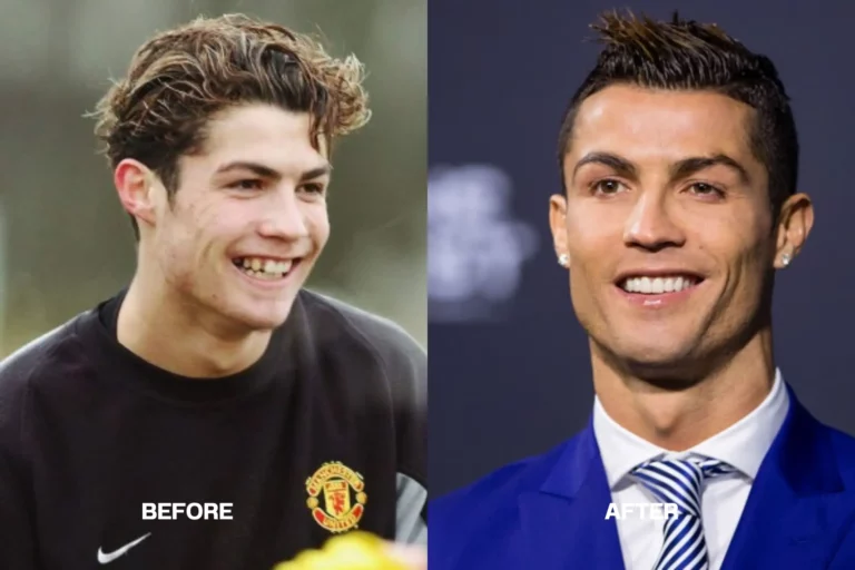 What’s behind Ronaldo’s teeth transformation?