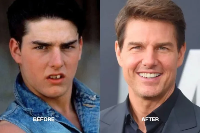 Tom Cruise Teeth: The Secret Behind His Perfect Smile