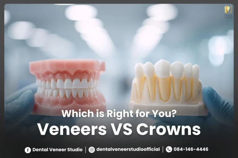 Veneers vs Crowns – Which Is Right for You?
