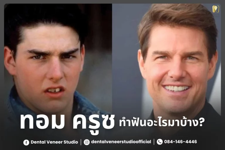ฟันของทอม ครูซ: ความลับเบื้องหลังรอยยิ้มอันสมบูรณ์แบบของเขา