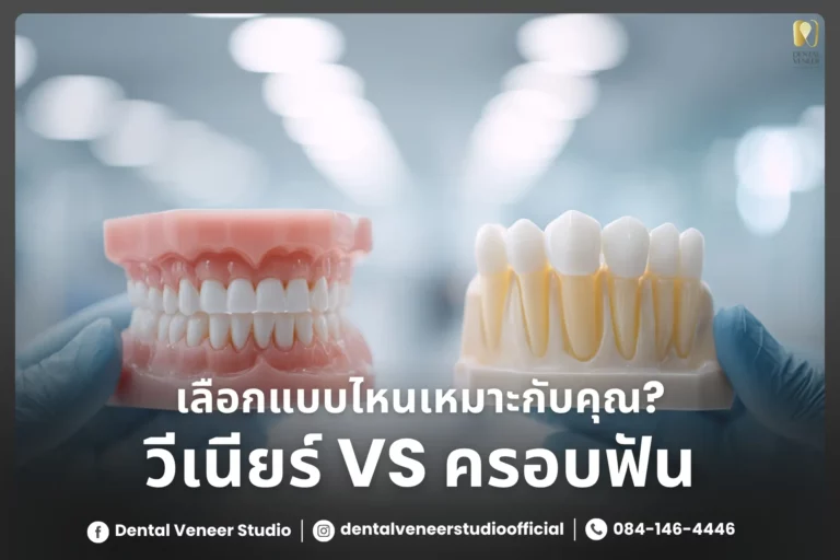 วีเนียร์ VS ครอบฟัน – แบบไหนเหมาะกับคุณ?
