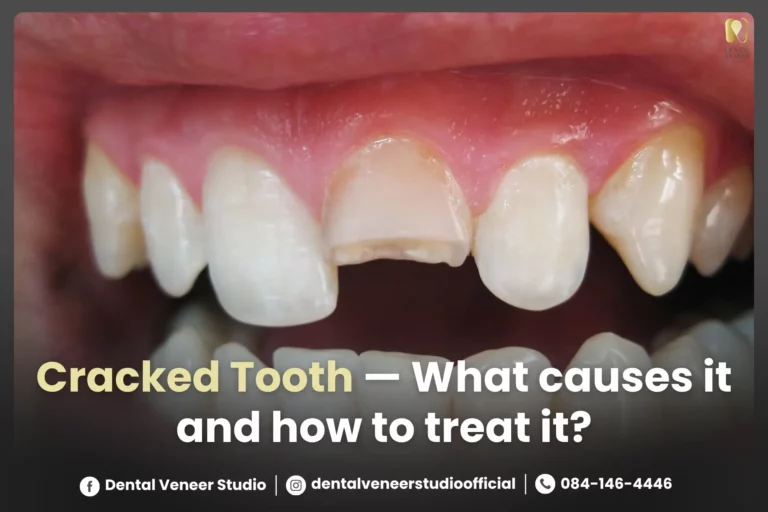 Cracked Tooth — What causes it and how to treat it?