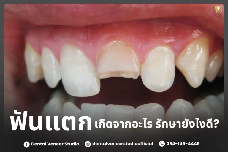 ฟันแตกเกิดจากอะไร รักษาแบบไหนดี?