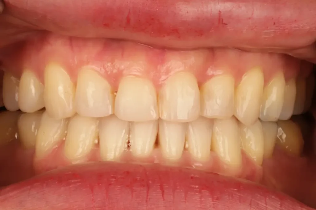 Close-up of naturally short and small teeth before dental veneer treatment (Case 5).