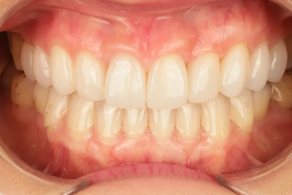 Close-up of reshaped and lengthened teeth with a beautiful, natural appearance after porcelain veneer placement.