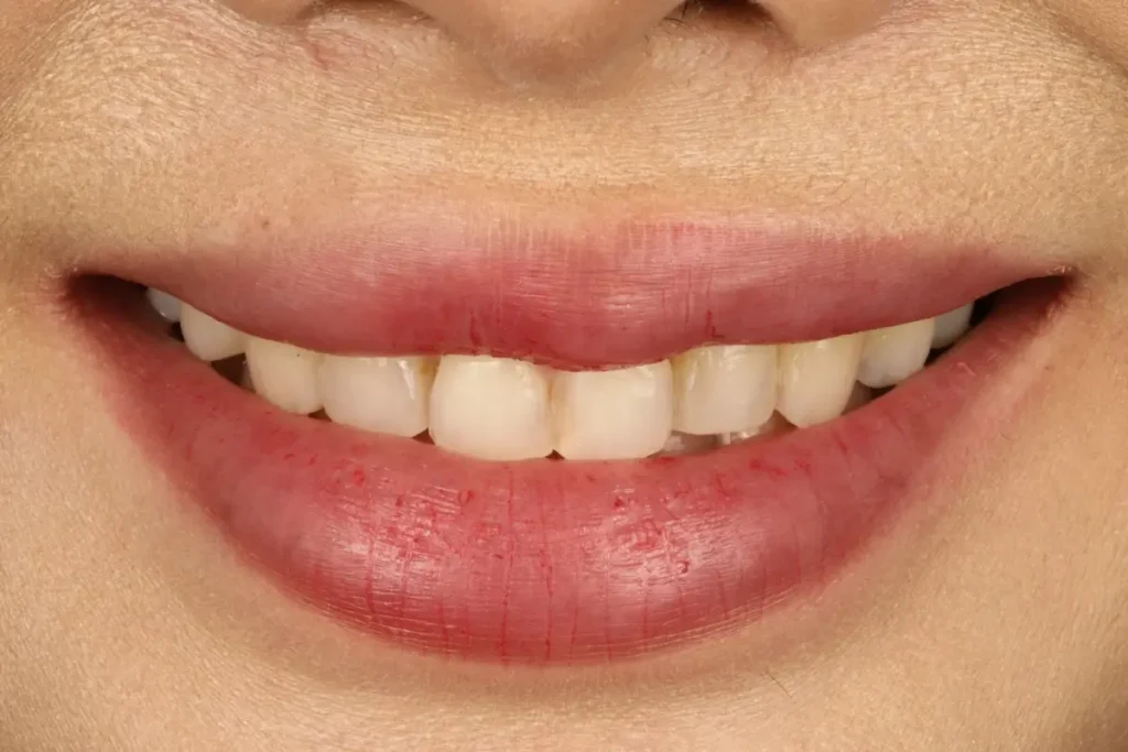 A patient's smile before getting veneers, showing short and small teeth that affect the smile's proportions.