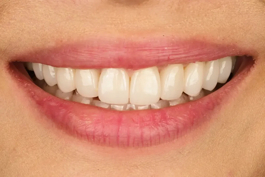 A beautiful and natural-looking smile after veneer treatment, showing fuller, well-proportioned teeth.