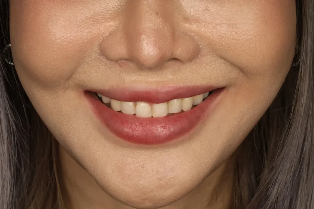 Lower face view of a patient smiling before veneer treatment to correct short and disproportionate teeth.