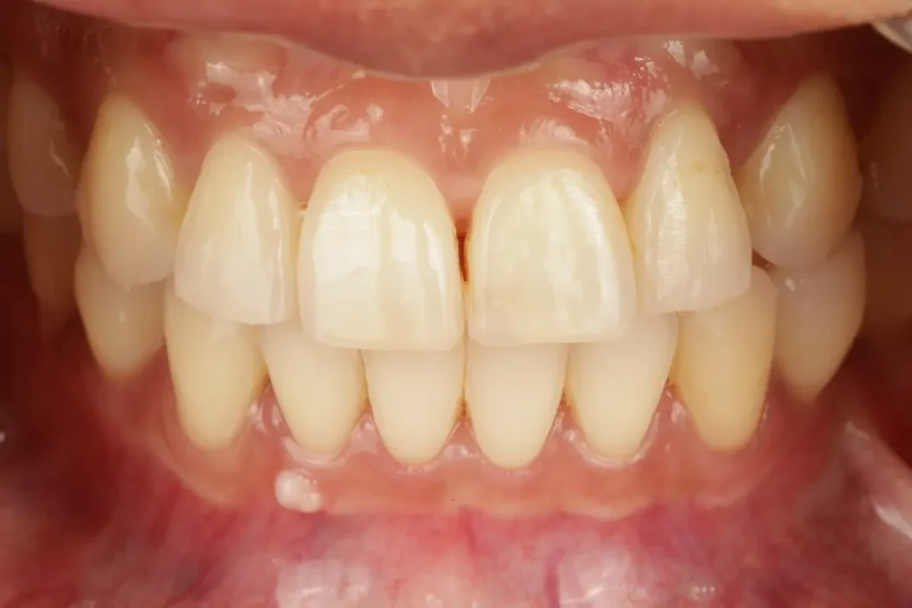 Close-up of naturally yellow and slightly misaligned teeth before dental veneer treatment (Case 6).