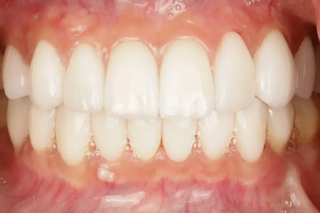 Close-up of bright white, perfectly aligned, and reshaped teeth after porcelain veneer placement.