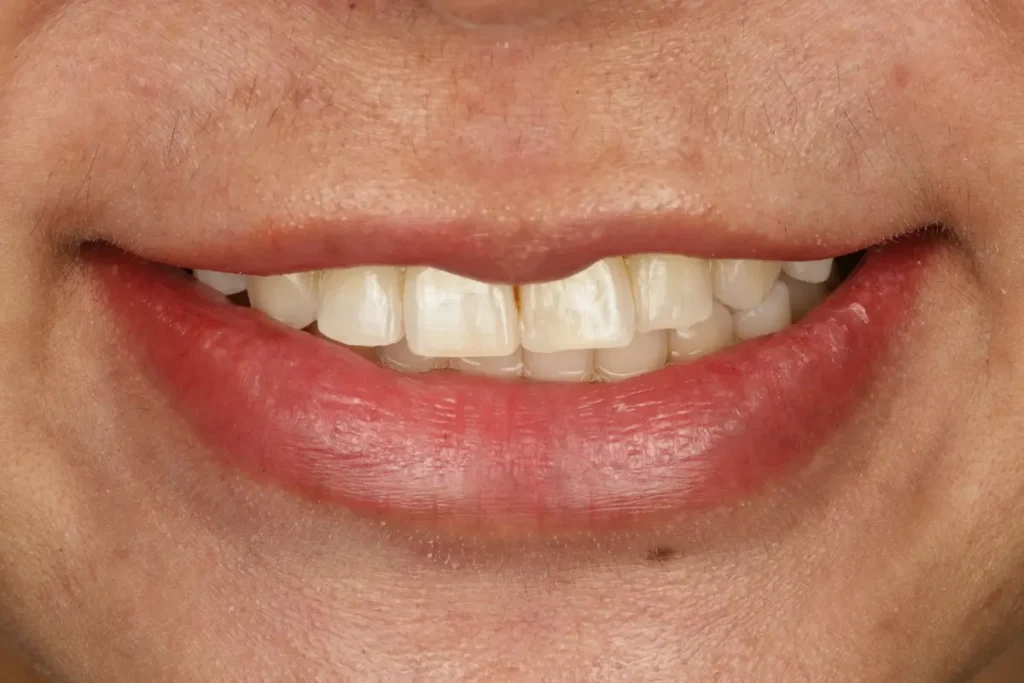 A patient's smile before getting veneers, showing yellowed and unevenly shaped teeth.