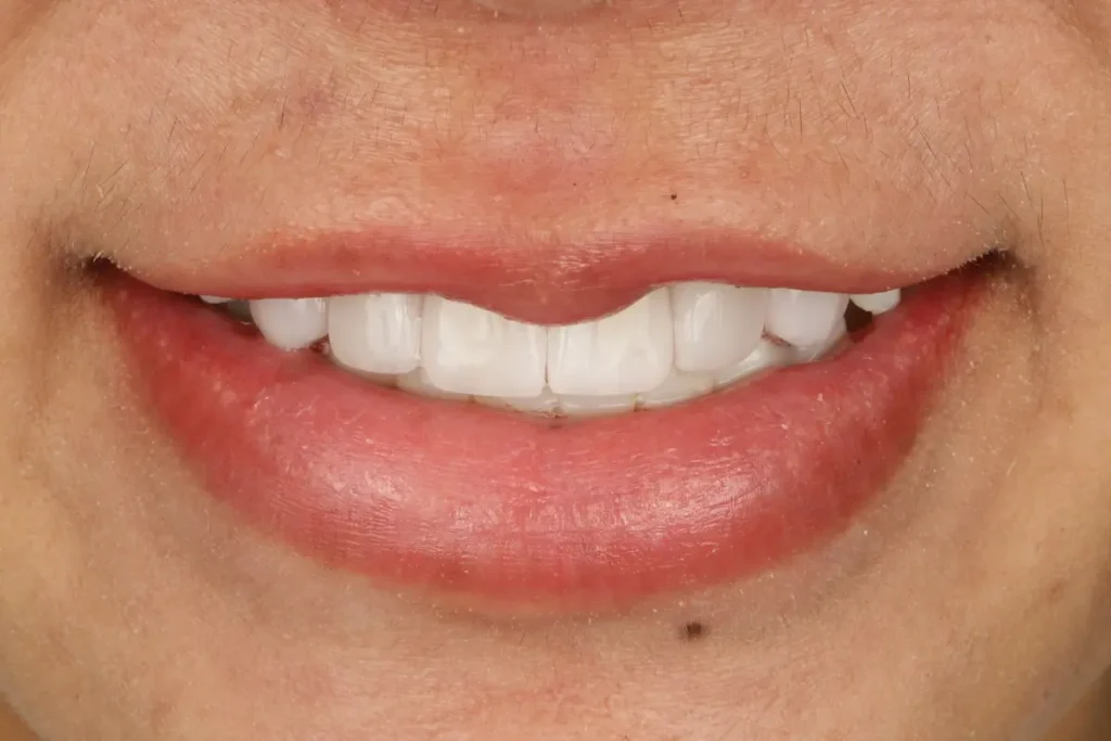 A confident and beautiful smile after veneer treatment, showing natural-looking white teeth.