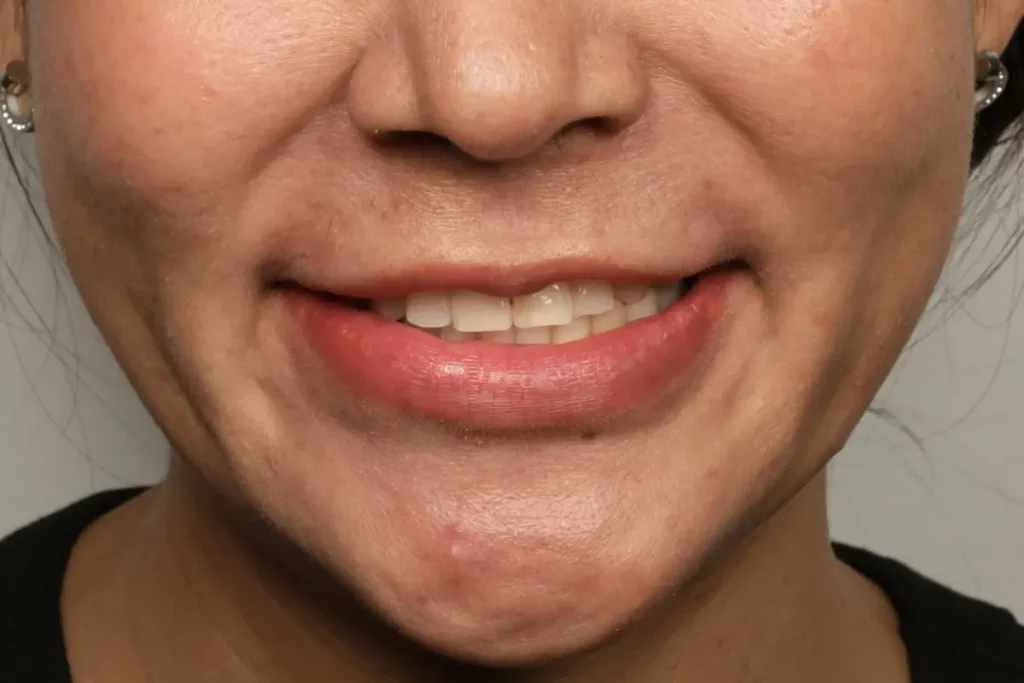 Lower face view of a patient smiling before veneer treatment to fix yellow and misaligned teeth.