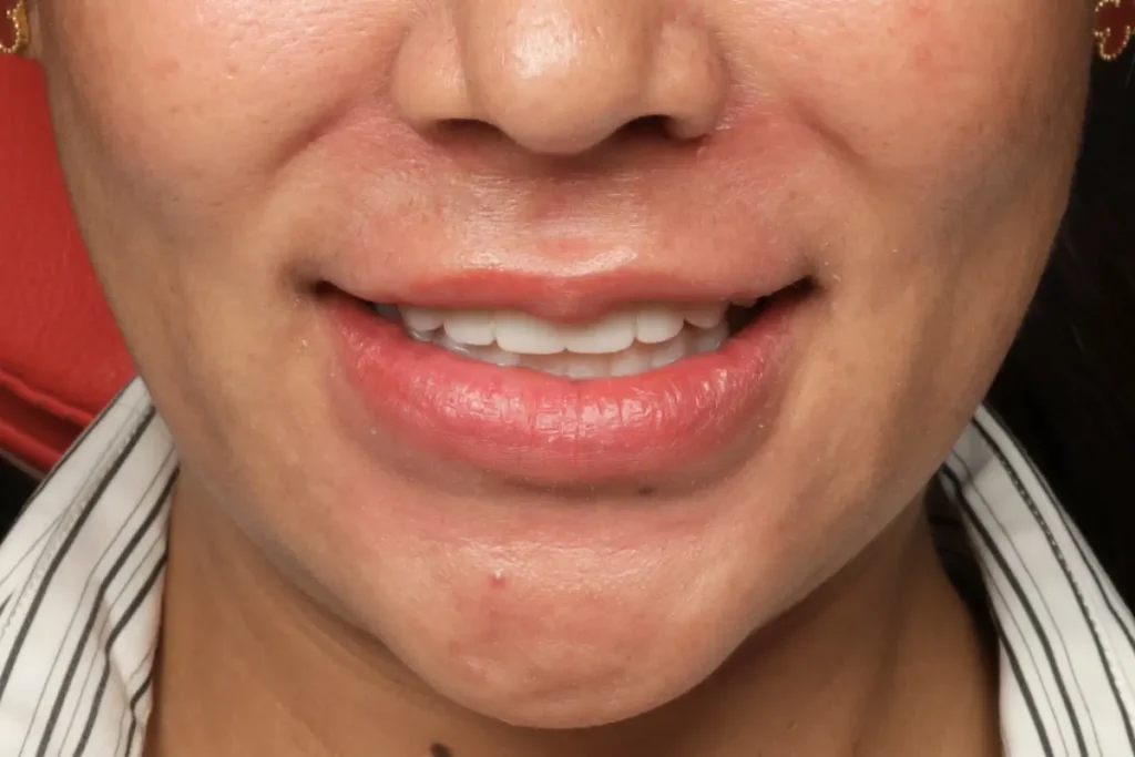 The stunning result of a smile makeover with veneers, showcasing a bright and confident new smile.