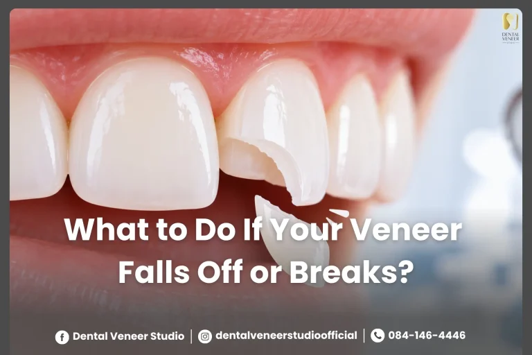 What to Do If Your Veneer Falls Off or Breaks? An Emergency Guide